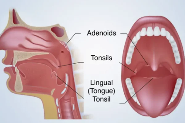 Adenoids Baddiehubpro.com